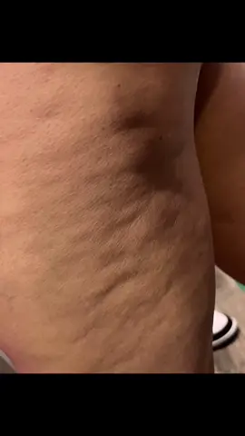 45ish days baking soda & salt in my drinking water. Biggest fat loss in my fitness journey so far. #cellulite #fitnessjourney #closeyourrings #956 #fyp @yodatheycallme