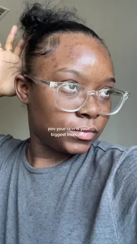 I feel like this challenge was for me 💗 #realskinchallenge #imperfectskin #skincaretiktok #skintextureisnormal