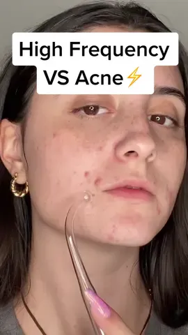 High frequency vs hormonal acne ⚡️ #highfrequency #skincare #acneskin #acneskincare #SkinCare101 #skincaretips #skincarehack #beautyhacks #acneskintreatment #acneremoval #acnecheck #acneproneskin #acnetips #acneisnormal #acneconfidence