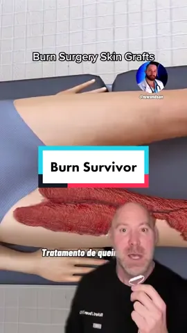 #duet with @niwandson #burn  #burnsurvivor #brownsanatomy