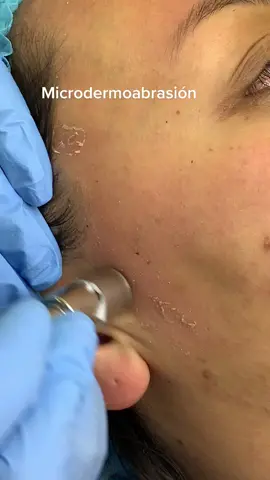 Microdermoabrasión elimina células muertas #fypシ #fyp #pamplonanortesantander #satisfying