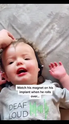 How magnetic are cochlear implants? This magnetic!