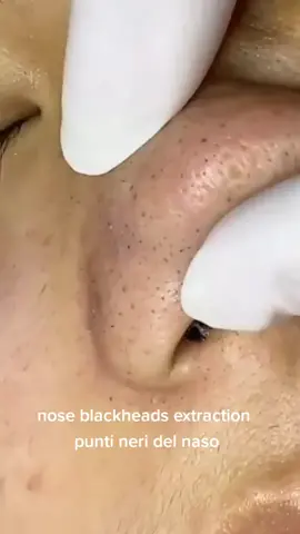 punti neri dal naso , nose blackheads #blackhead #satisfy #puntineri #pimple #brufoli #skincare