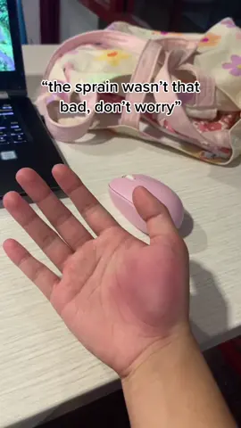 I should’ve iced it straight away #bruise #sprain #thumb #palm #uoa #uni #auckland #halls #injury