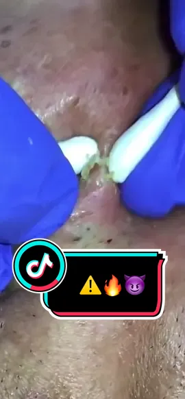 #puntosnegros #espinillas #barros #quitandoespinillas #fyp #cara #grano #extremo #fy #fm #placer