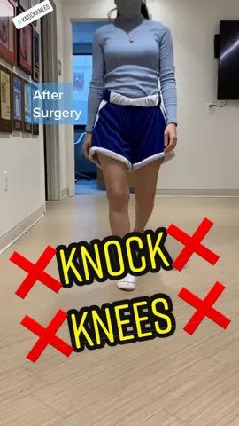 😄 Knock Knees No More! Comment your thoughts below👇 #knockknees #knockknee #genuvalgum #valgusdeformity #ComeDanceWithMe #ScreamItOut #perfect #surgerytiktok #beforeandafter #doctorsoftiktok