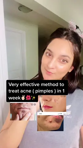 @beautysecrets23 @beautysecrets23 @beautysecrets23  very effective and fastest method to treat acne ✌🏻✨👩🏼 first know your pimple type and then do treatment #glowithtanisha #skintips #acnetreatment #skincareroutine #periodacne #diduknow #skincaretips #icefacial #beautyhacks #fyp #firstclass