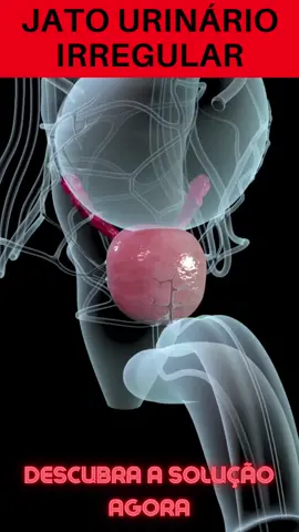 Urina irregular #urina #prostata #prost #prostatagrande #prostatainflamada #saudedohomem #hiperplasia #hiperplasiaprostatica #medicina #tratamento