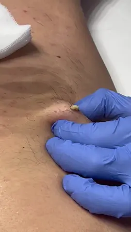 Per la rubrica: “rimozione cisti” ecco quella fatta oggi 🌋 #studiomedicodepaoli #studiomedico #medicinaestetica #rimozionecisti #popit