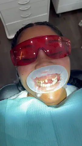 Patient loss teeeth due to early childhood trauma. Removed old restorations and restored her teeth and facial aesthetics with Porcelain Veneers🥶 Dr.Q #fyp #foryou #dentist #memphis #atlanta #veneers #cosmetics #teeth #viral #fypシ