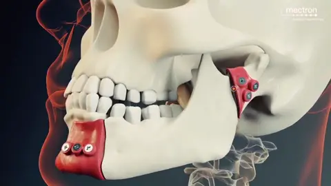 mandibular #reconstruction #repair #