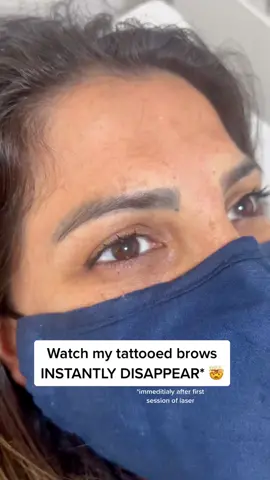 ✨INSTANT SPMU LASER REMOVAL RESULTS✨#spmu #tattooremoval #bye #quanta #closeyourrings #tattoo #tattoos #devon #southwestuk #qplus #BROW #brows #beauty #instantresult