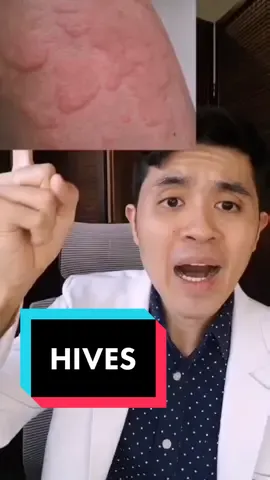 Doc Ramon’s here to talk about hives. Let’s listen! 🧑🏻‍⚕️✨ #EduWow #EduTok #edutokph #fyp This video is based on the medical professional’s assessment and not to be interpreted as KonsultaMD’s position or as medical advice.