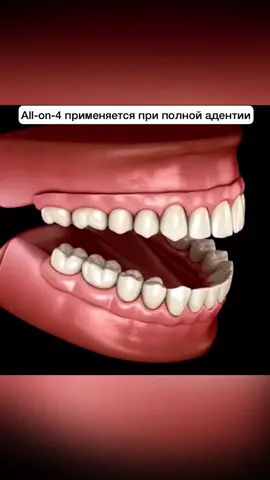 Бюджетная имплантация? Бывает?Что такое технология All-on-4?#стоматологическийтуризм #коронканазуб #имплантациязубов #имплантация