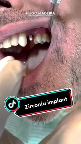 Cada vez faz mais sentido colocar implantes de zircónia. Quem advinha porquê? 😏 #hugomadeira #implants #dentistry #dentistrylife #dentistryworld #tiktokdentistry #dentistsoftiktok #zirconia #zirconiaimplants #crown #dentistlife #fy #viral #SextaFeira13
