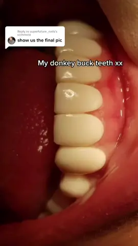 Reply to @superfuture_nails #veneers #compositeveneers #compositeveneers #fail #teeth