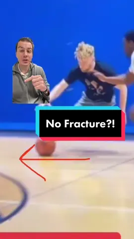 #stitch with @overtime the force it takes to break a bone can be misleading because it can happen easily in the right position. He is very lucky that position didn’t occur. #basketball #NBA #ballislife