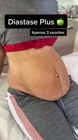 Diastase Plus em andamento ! Apenas 3 sessões e já temos esse resultado maravilhoso! #metodoxemagrecimento #diastaseplus #acordapedrinho