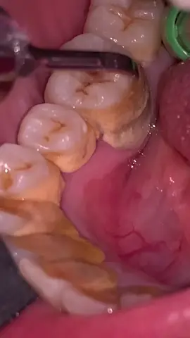 #doktergigi #doktergigitriputra #karanggigi #scaling #tartar