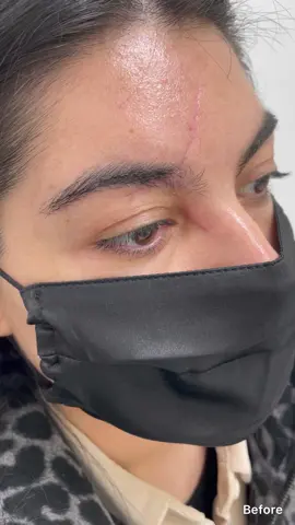 Scar treatment #basmahameedclinic #beverlyhills #toronto #scars #accident #story #keloid