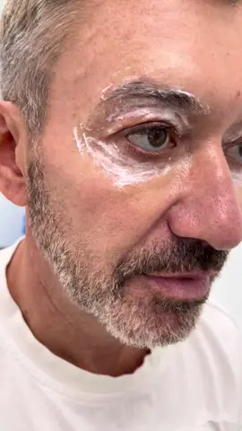 We have many male patients who are bothered by their baggy eyelids. This gracious patient allowed us to share his surgery video to increase awareness of male CO2 laser blepharoplasty procedures. Thank you!