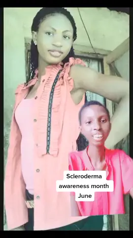 #greenscreen#violetemor #violetemor95 #viral #sclerodermawarrior #sclerodermaawareness