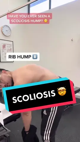 I’ve got a 35 degree bend in my spine. I could have been a few inches taller 🥹 #physiobae #scoliosis #scoliosischeck #scoliosisawareness #scoliosisgang
