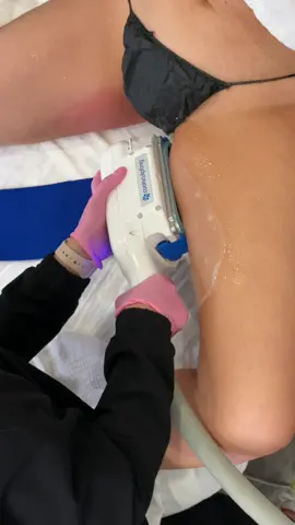 Sculpting thighs and saying our goodbyes to stubborn fat, just in time for summer. #coolsculpting #fatfreezing #bodycontouring #summerprep #fyp