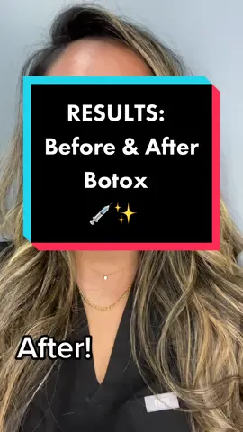 Before & After: routine Botox #botox #dysport #beforeandafter #skincare #SelfCare #maintenance