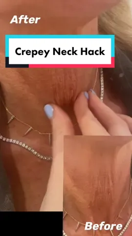 Crepey neck skin hack #dermtok #skintok #cetraben #turkeyneck #dermatologist #pillowtalkderm #shereeneidriss #crepeyskin #crepeyskintreatment @shereeneidriss