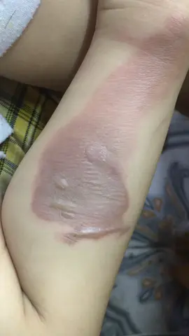 Mọi người biết cách trị bỏng bô xe máy nào hiệu quả, và không để lại sẹo không ạ? Chỉ cho em với ạ?  E lo con em bị sẹo sau này quá 😭😭#phaibong