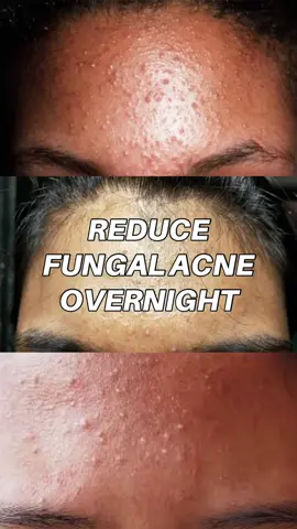 This is the best at home remedy for #fungalacne #SkinTok #acnecheck