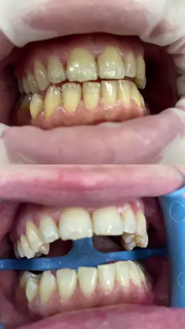 #sbiancamentoprofessionale 🦷 #perteeee #viralvideo #dentiperfetti