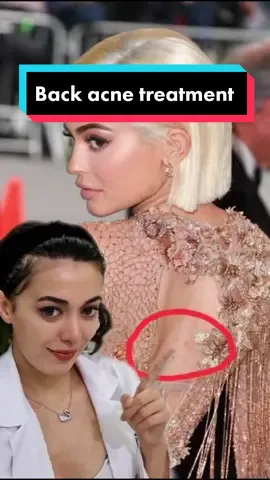 Even celebs have back acne! Try this treatment for 3 months and you will be fine ❤️✨️#backacne #acnetreatment #acne #skincare #skintreatment #fyp #FYP #health #hacks #LearnOnTikTok #foryou