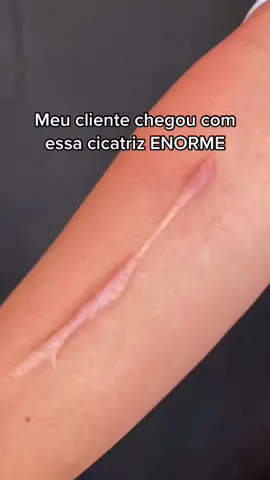 Cobertura de cicatriz, essa foi complicada mais sumiu! #tattoo #tatuagem #coberturadetatuagem