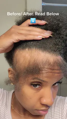 The pain was unbearable 😫 my mission is to spread awareness regarding lichen planus. How did I grow my hair back? Using organic products from my hairline. Link in bio Grow Me Oil - Promotes hair growth Heal Me Oil- Assistance with dandruff and inflammation Relax & Relief Oil Treatment- Promotes hair growth, thicker hair, increase hair strength and reduce dryness on scalp#lichenplanus #lichenplanusautoimmune #hairloss #hairgrowth #frontalalopecia #lichenplanus #blackwwomen