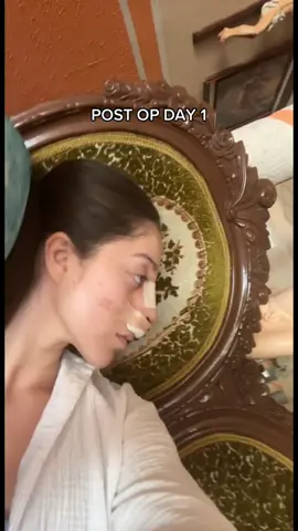 nose job in 🇲🇽 #rhinoplasty #nosejob