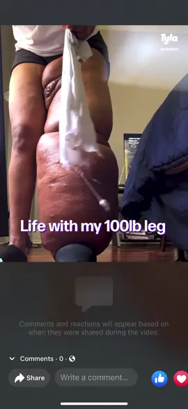 I can’t believe I got to a point where now I show my FULL LEG like my birthmark / papilloma and everything . For the longest I was so nervous to let that show 😳, but now here I am 🥹. Thank you @tyla.official 💙. PLEASE DON’T FORGET TO CLICK THE LINK IN BIO ❣️. #fyp #CheetosReaperReactions  #viral #lymphedemaawareness #lymphaticdrainage #ItsGreatOutdoors   #beautiful  #medical #body #bodypositive #Love #instagood #tyla