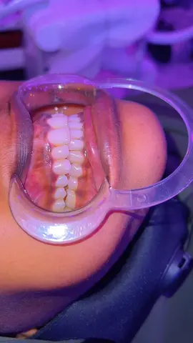 Ceramic braces with my patient from Kismaayo  I have done more than she expected and I am very happy for that.#kakaaftooncabashada🇸🇴🦷🇲🇾 #somalitiktok