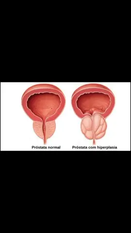 O que é a próstata aumentada? Próstata aumentada, ou, conhecida como hiperplasia prostática (HBP). É uma doença que ataca os homens entre 40 a 60+ anos, causando sintomas como: fluxo urinário fraco, retenção urinária, dificuldade para urinar, maior frequência de idas ao banheiro, sagramento na urina (hematúria) e noctúria (vontade de urinar durante a noite. O gota Prost chegou no momento certo e é eficaz contra os sintomas da próstata aumentada. #sementedeabobora #prostatagrande #tratamento