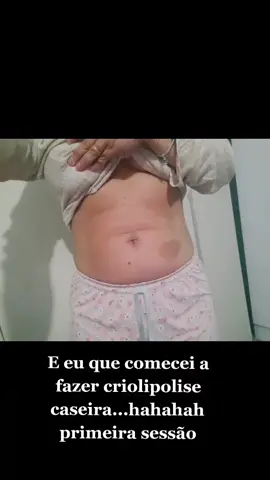 #criolipolisecaseira #fy #tiktok