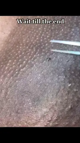 This one was in there for 2 years 🫠 #getitout #extractionsatisfaciton #ingrownhairremoval #ingrown #galaxyextraction