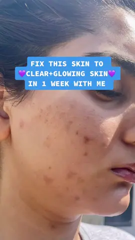 This to clear in 1 week!💜 #foryoupage #foryou #PUBGMobileMadGala #trending #skin #skincare #acne #acneskin #clearingacne #desi #asiangirl