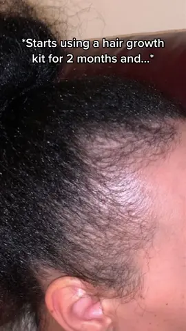 Our Origin bundle is just amazing! #hairregrowthjourney #tractionalopecia