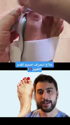 #Duett mit @john.smith.10 #halluxvalgus