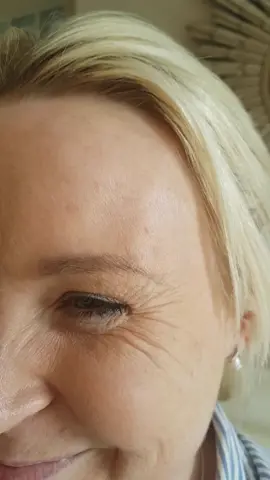 Anti Wrinkle injections last approximately 3 months (and longer the more you have them administered!).. and are literally magic #antiwrinkle #consultantclinic