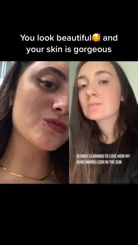 #duet with @e.laiiney #acnepositivity #skinpositivity #acneconfidence #acneisnormal #normalizenormalskin