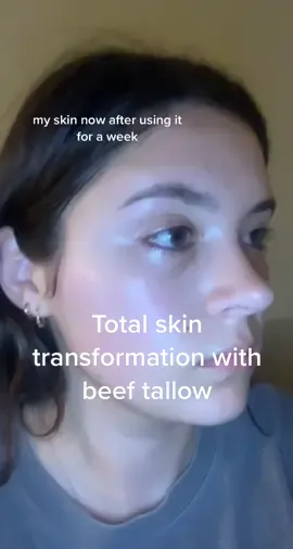 i will use beef tallow on my face until i die #skintransformation #acneproneskincare #beeftallow #beeftallowskincare #allnaturalskincare #clearskin #glassskin