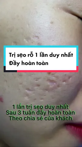 Ult phải chúc mừng cô này thật nhiều.#sẹo_rỗ_mất_sắc_tố nặng. Tới #vspa trị đúng 1 lần sau 3 tuần kết quả đầy hoàn toàn. Nói điêu trời lấy mất lộc nhé #sẹorỗ #sẹo_rỗ_sẹo_lõm_sẹo_lồi_sẹo_tai_nạn_vspa