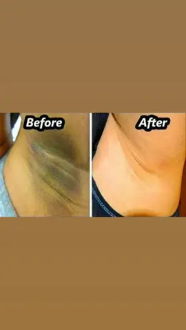 Treatment for DARK UNDERARM with Laser ! …Book your appointment on: 5927 7608 / 5292 0552#JRBeautyClinic #JR #JRBeauty #Skin #Treatment #Hyperpigmentation #darkunderarmsolution  #DarkUnderArm